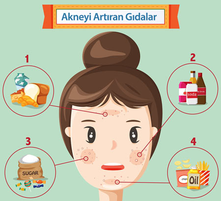 akneyi-artıran-gıdalar