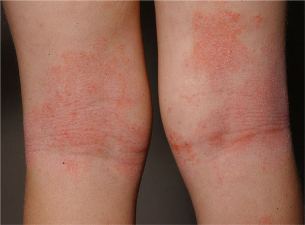 atopic-dermatitis