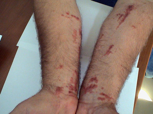 incir-dermatiti